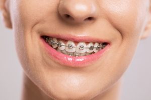 Tem aparelho nos dentes? Saiba como cuidar da saúde da boca!